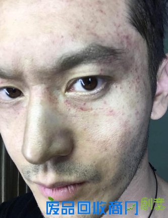 黄晓明倒挂脸部充满血丝