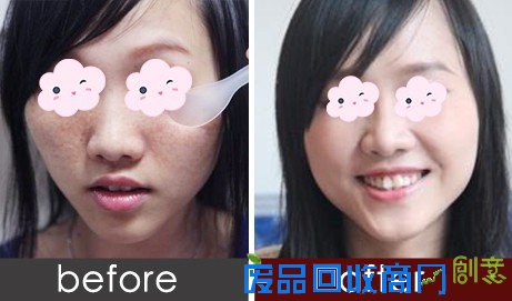 悦美APP：激光祛斑真的会反弹吗？1