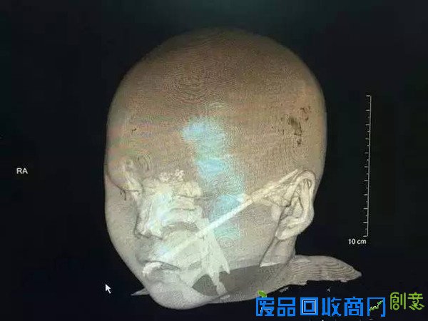 宝宝眼睛被插伤竟致命！盘点孩子身边的潜在“杀手”！